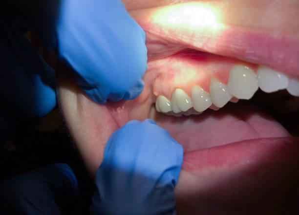 Best Walk-In Emergency Dental Services in St Louis, MO